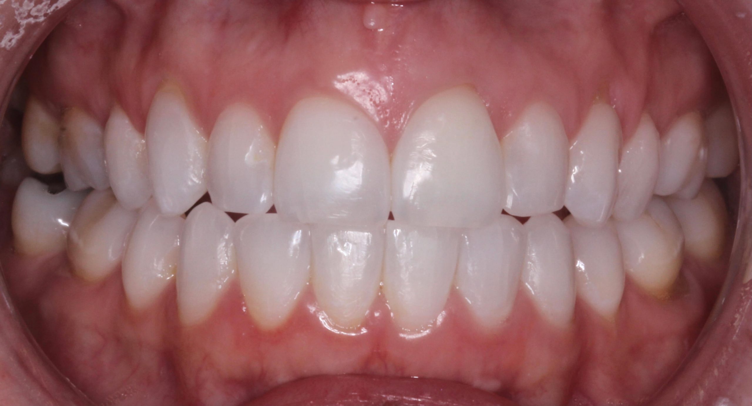 Invisalign - After