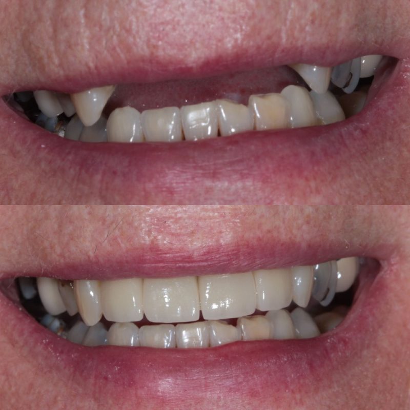 Dental Implants | Greygables Dental | East Kilbride